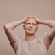Women with Alopecia Totalis