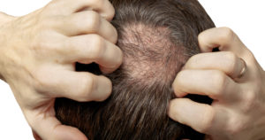 Thinning Hair On A Man