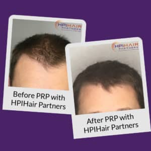 Before After PRP
