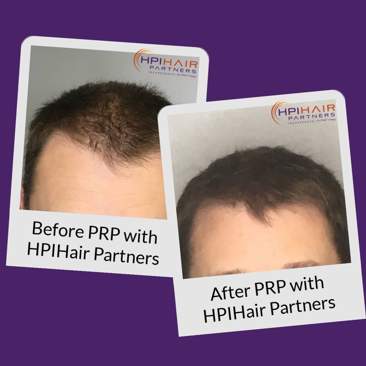 Before After PRP