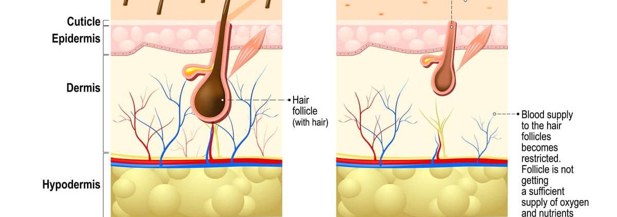 Alopecia Hair Loss