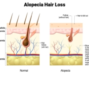 Alopecia Hair Loss
