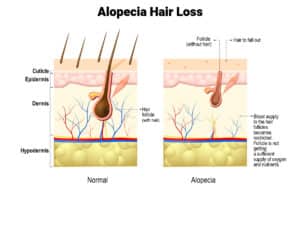 Alopecia Hair Loss