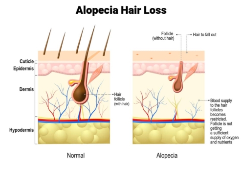 Alopecia Hair Loss