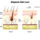Alopecia Hair Loss
