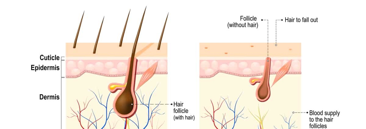 A diagram illustrating the stages of hair loss in Alopecia areata.