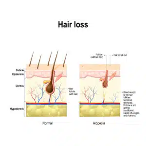 A diagram illustrating the stages of hair loss in Alopecia areata.