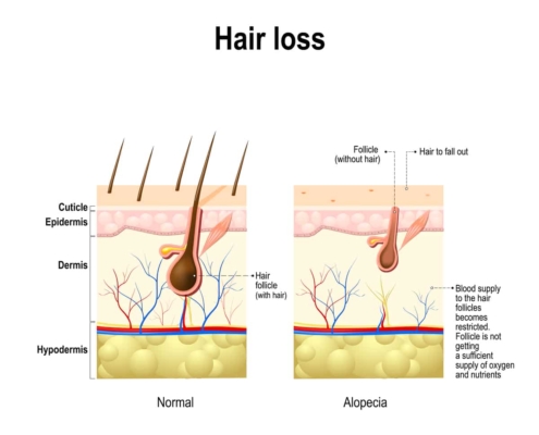 A diagram illustrating the stages of hair loss in Alopecia areata.