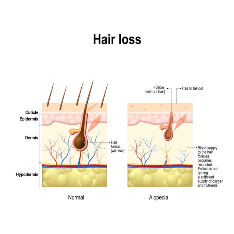 A diagram illustrating the stages of hair loss in Alopecia areata.