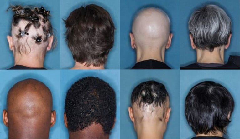 Alopecia Examples