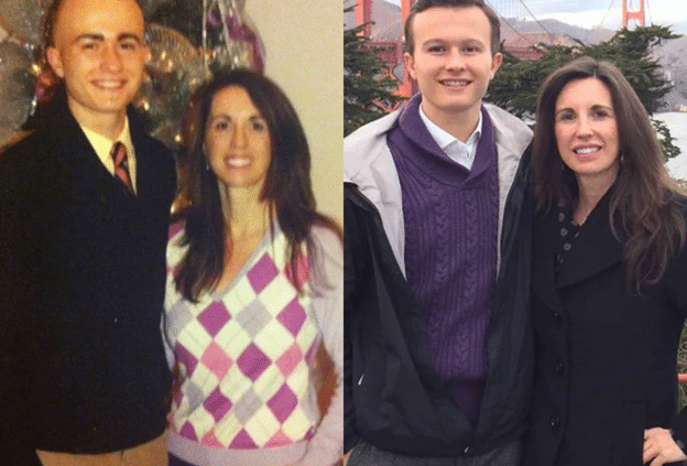 Photo of Will Siskey diagnosed with alopecia areata treatment before and after