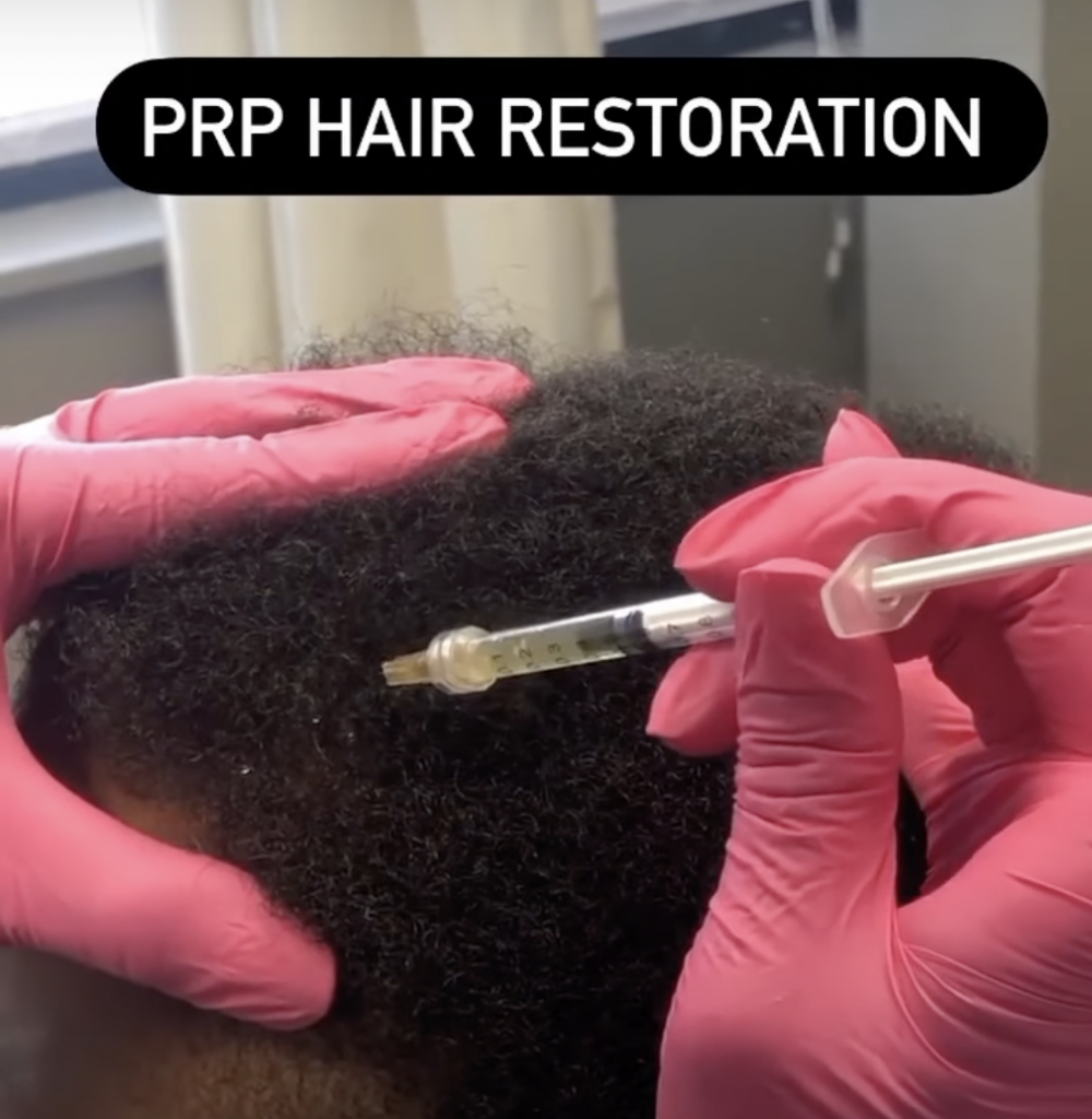 prp hair restoration thumbnail