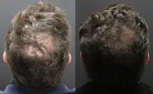 Before and after Alma TED technology for hair restoration results density results of a man