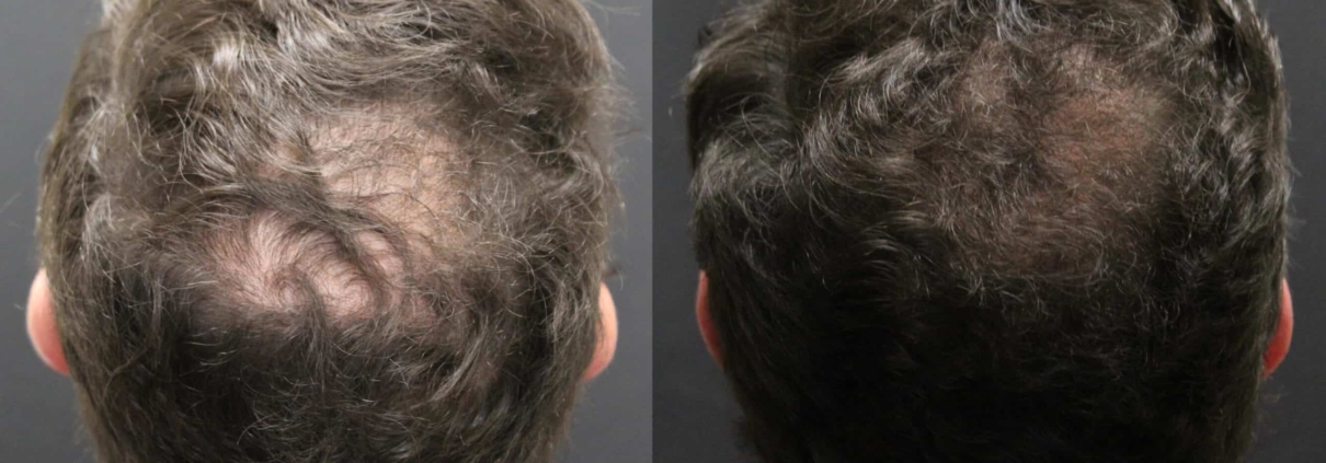 Before and after Alma TED technology for hair restoration results density results of a man