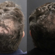 Before and after Alma TED technology for hair restoration results density results of a man