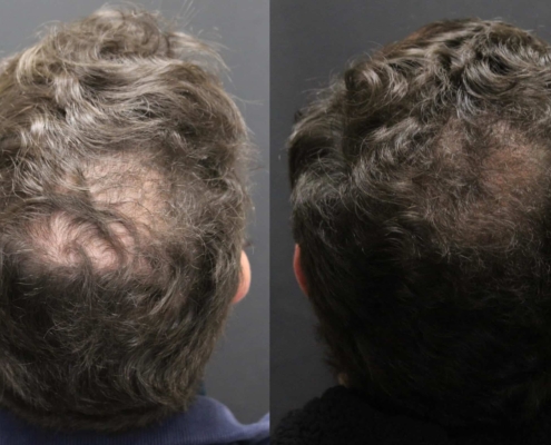 Before and after Alma TED technology for hair restoration results density results of a man