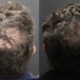 Before and after Alma TED technology for hair restoration results density results of a man