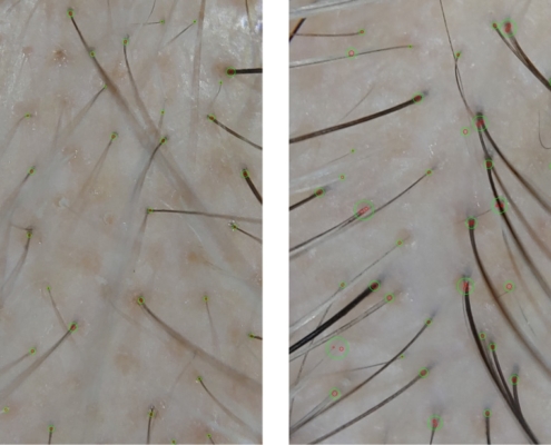 Alma TED technology for hair restoration results density