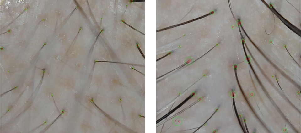 Alma TED technology for hair restoration results density