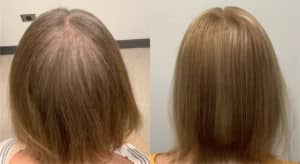 Before and after Alma TED technology for hair restoration results density results of a woman