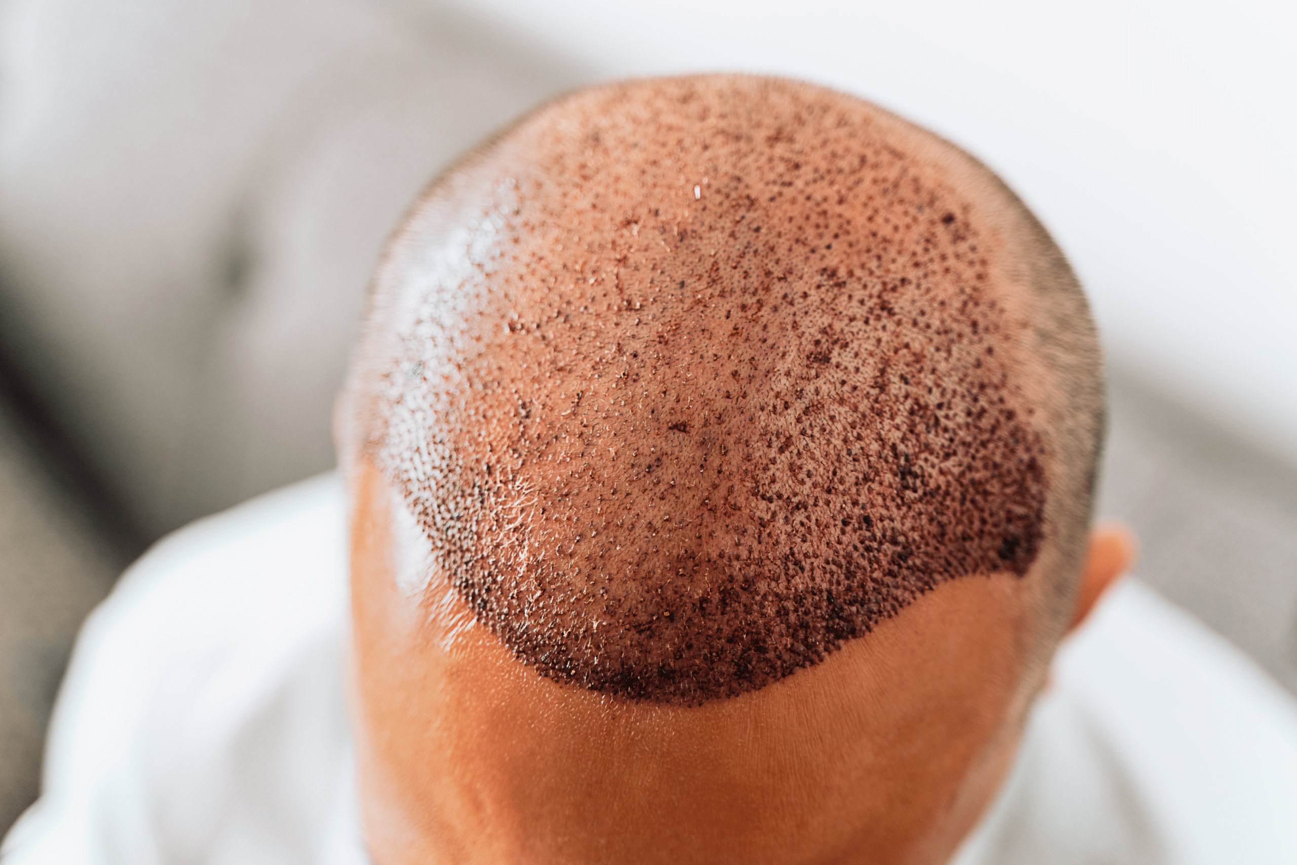 A man with a bald spot on his head.