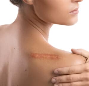 A person who visited a clinic for scar revision now has a prominent scar on their shoulder.