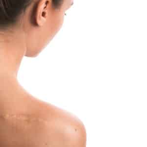Profile of a woman showing a scar on her shoulder, post Scar Revision at the clinic.
