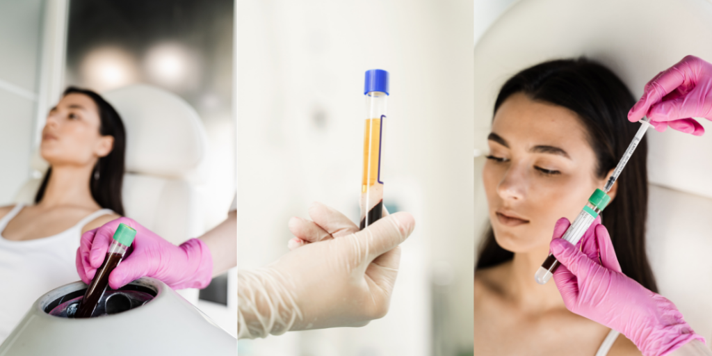 platelet-rich-plasma-prp-therapy