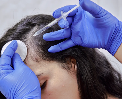 Exosomes & Hair Regrowth