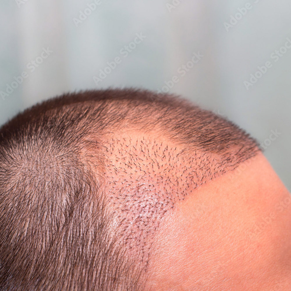 subpagefeatureimages_hairtransplantcons