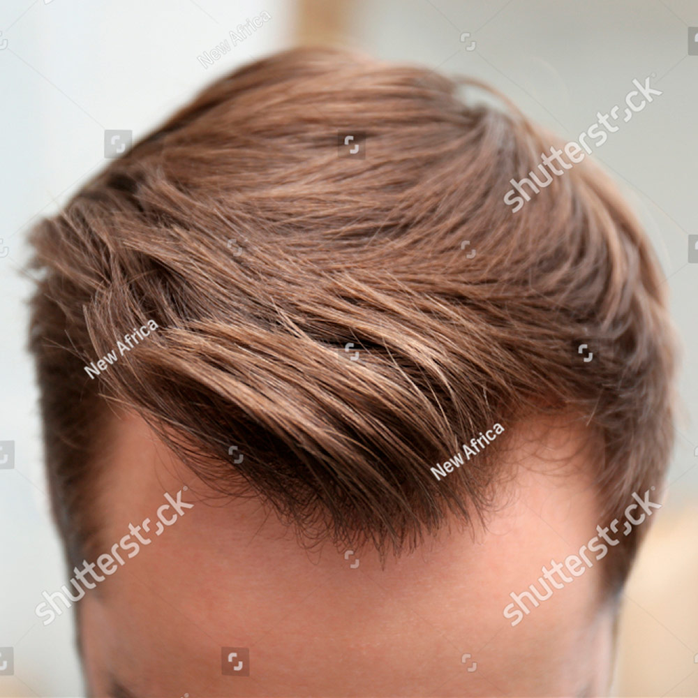 subpagefeatureimages_hairtransplantpros