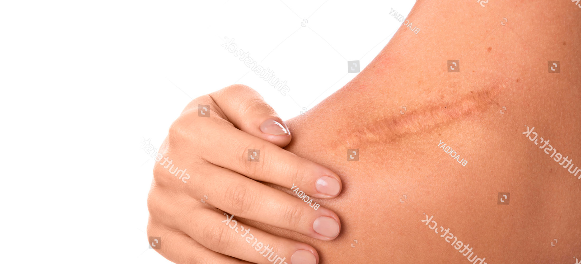 subpageheader_scarrevision