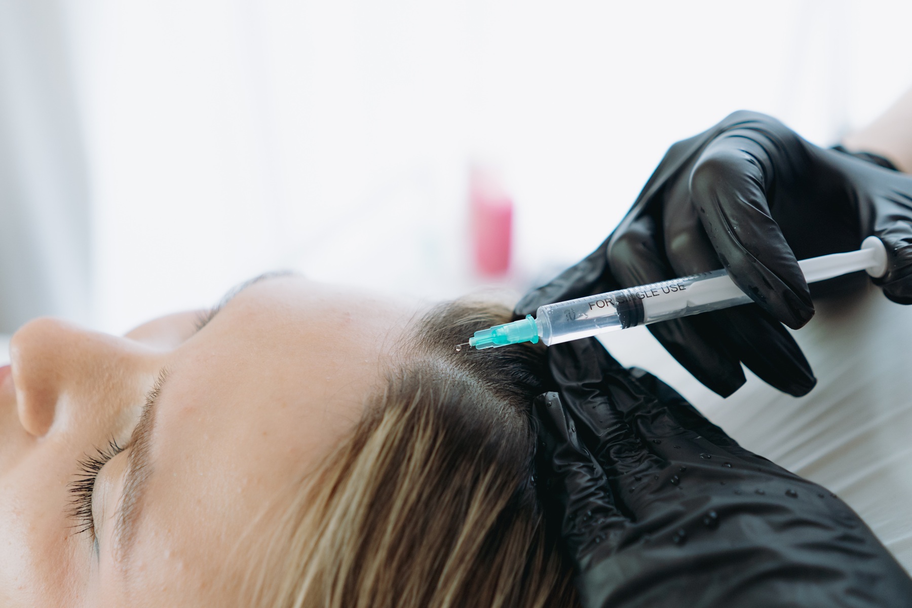 Hair Loss Trends Explained