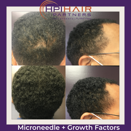 Microneedling with growth factors is a revolutionary treatment that utilizes the power of microneedles to stimulate collagen production and improve skin texture. This procedure is suitable for both men and women