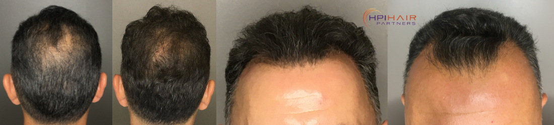 before-and-after-prp-treatment